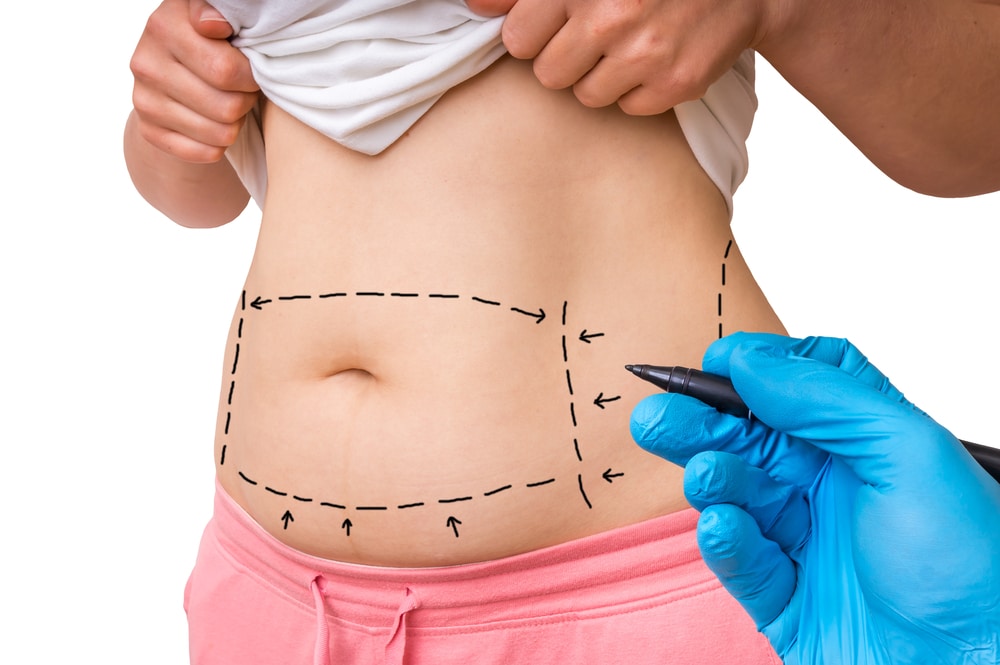 Tummy Tuck and the Importance of Follow-Up Appointments