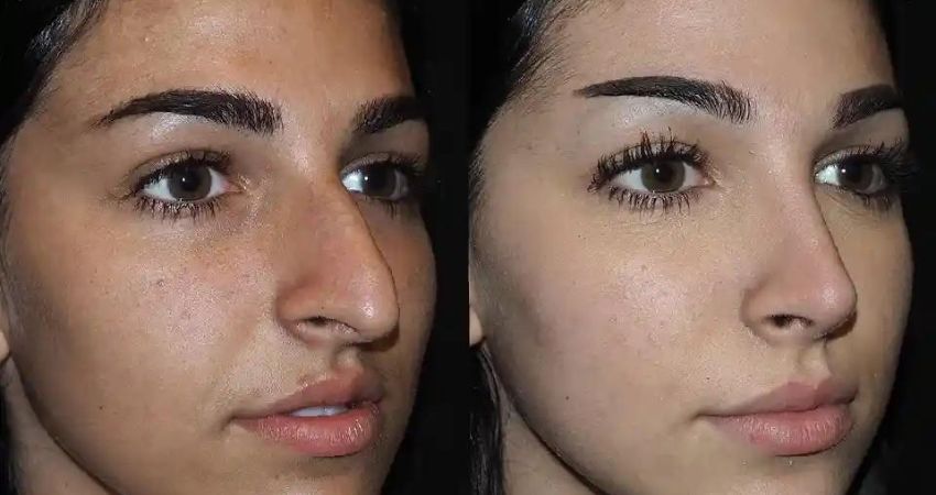 The Cost of Rhinoplasty: What Influences the Price?